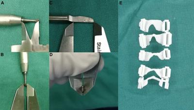 The application of three-dimensional printed patient-specific drilling templates for expansive open-door laminoplasty: A single-center, prospective randomized controlled study